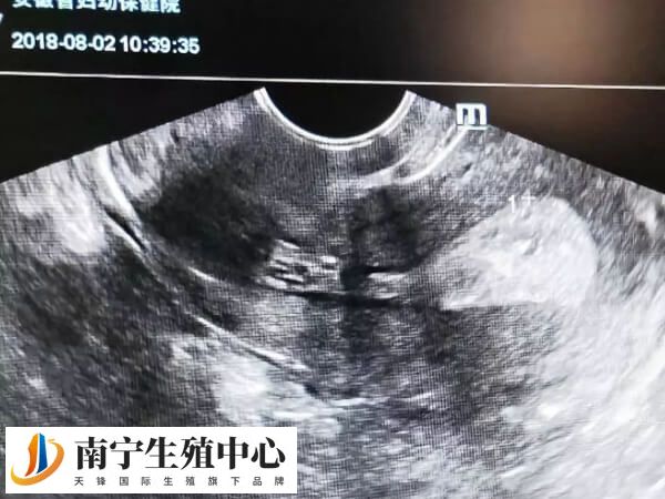 内膜薄可能是激素水平降低所致