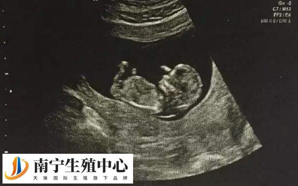 孕4个月胎停几率并不大