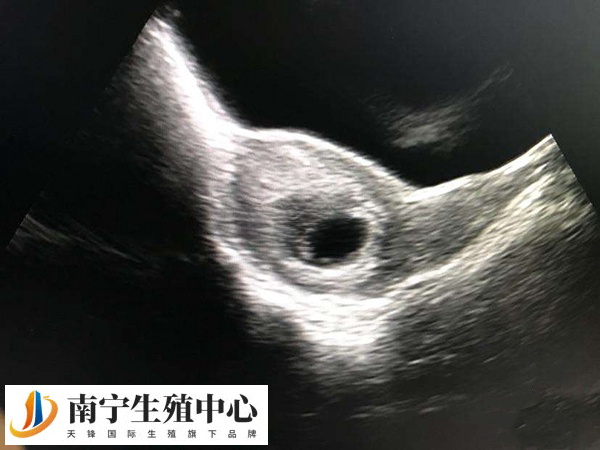 高龄孕妇胎停的几率大